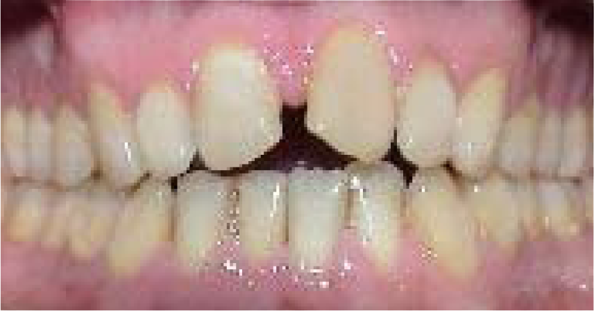 Diastema mediale in Frontalansicht
